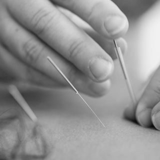 Close-up of a dry needling treatment being performed.